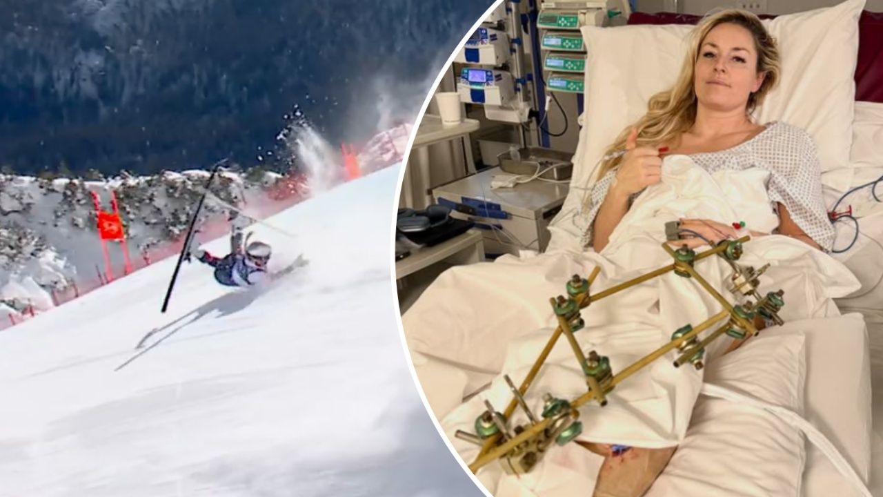 Vonn czeka na kolejną operację. „Takie urazy mogą zakończyć się amputacją”